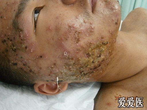 面部痤疮伴感染