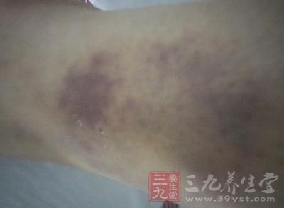 白血病症状 身上这处现淤青暗示患白血病