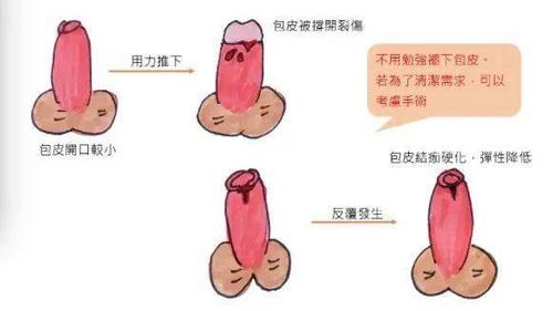 男孩的丁丁要如何正确保护