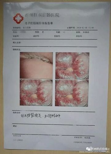 指导意见: 一般肛周脓肿术后40多天可以愈合,清理干净创面不