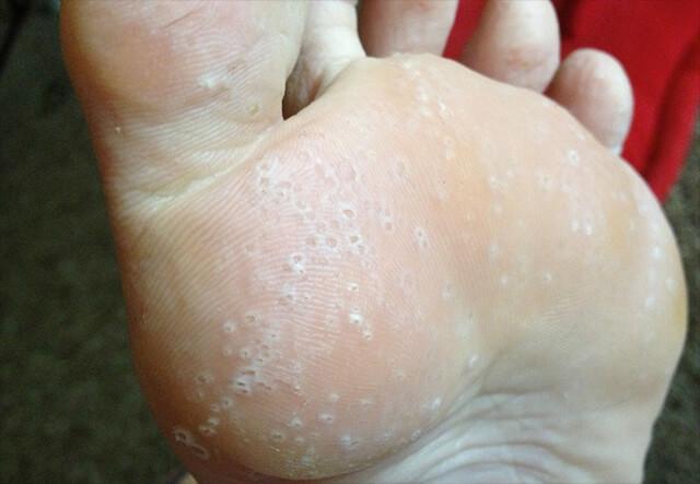 窝状角质松解症图片