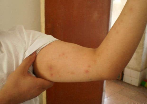 40万"艾滋病者"尚未发现?不论男女,皮肤有这"怪象"要当心