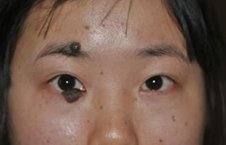 严重眼睑色素痣治疗康复图