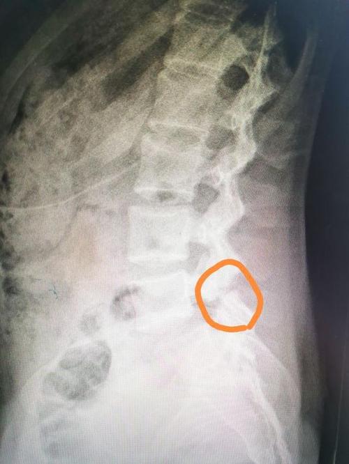 腰椎滑脱的治疗