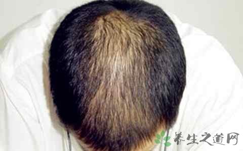 肾虚脱发什么症状