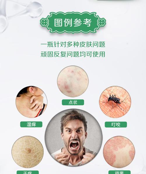 顽固皮肤瘙痒湿痒红疹癣干痒脱皮脸过敏性修复身体止痒膏药草本霜_好