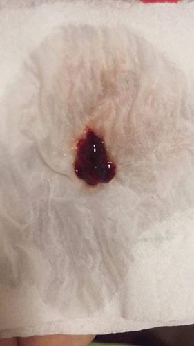 咳嗽咳出来脏东西这