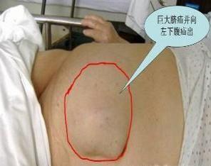 小儿疝气的症状图片,小儿疝气图片大全_小儿疝气_39