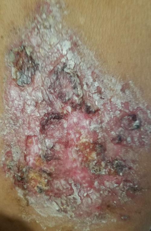 这是西医的处理方式治疗图,其中加了半次姜子牙万能膏(抹上后没多久被