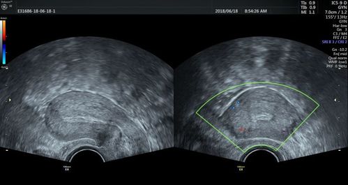 生殖超声系列介绍第二篇