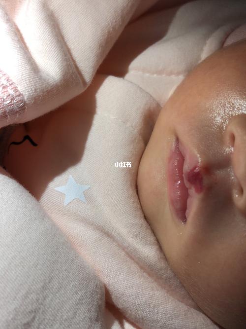 宝宝生出来一个星期嘴上就长了个血管瘤 图一是20多天