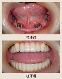 全口种植牙的优点有哪些