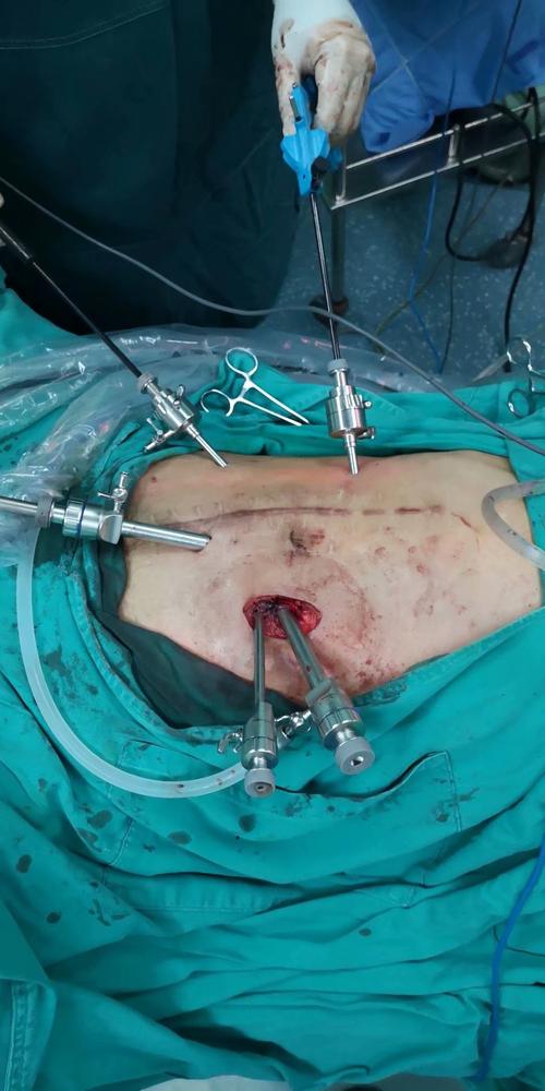 其它 腹腔镜造瘘口还纳 写美篇 术前图片,患者用人造肛门排便.