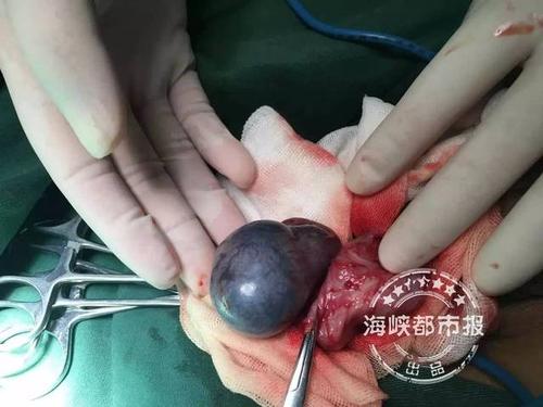 厦门小男孩睾丸高度扭转,黑的像葡萄,最终被切除.只因家长忽略了这个!