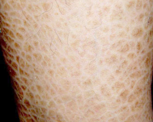 鱼鳞病是什么原因造成的?_东莞南城肤康皮肤病科门诊部