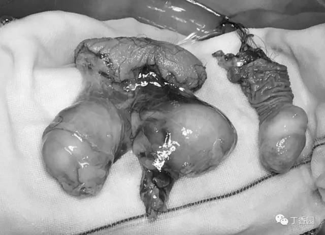 抑郁症患者切下自己的阴茎和睾丸,医生是如何缝回去的