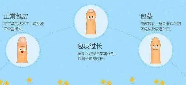 包皮粘连 包皮粘连一般是指包皮皮肤的内板与冠状沟和阴茎头粘连,很难