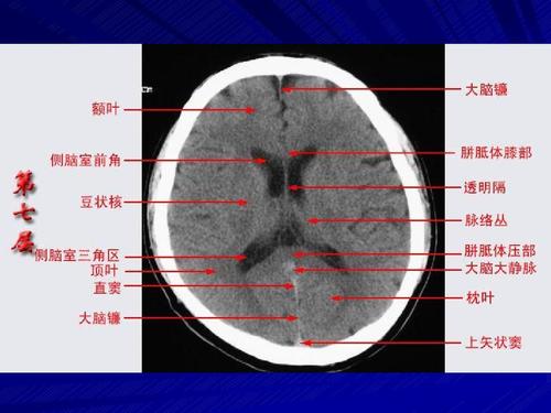 头颅ct断层解剖