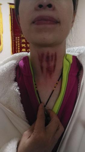 普通感冒,鼻流清涕咽痛.