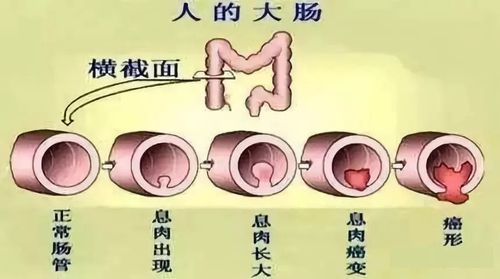 前者与大肠炎症反应有关,后者则由于结肠粘膜表面细胞更新的不平衡