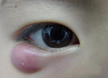 麦粒肿,是一种急性细菌性化脓性的炎症,多半与不注意手部卫生并揉眼睛