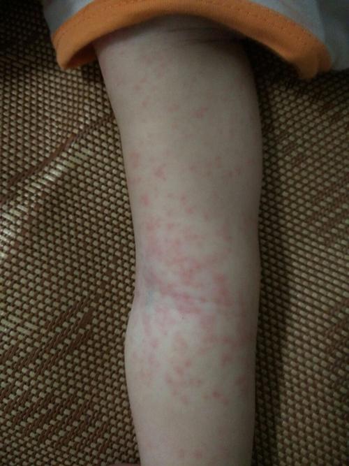 不吃就又上升,发烧第三天去医院检查了血,说是病毒性感冒,昨天第四天