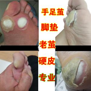 手茧脚茧去除手脚茧老茧硬皮脚后跟死皮脚垫祛脚趾关节茧子