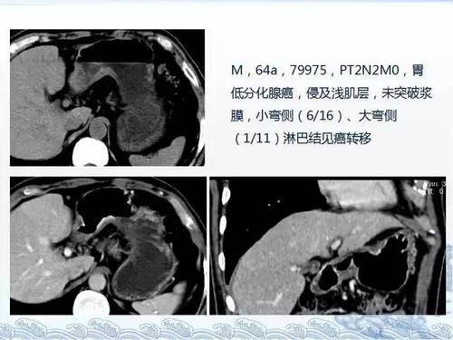 ct检查及诊断攻略——胃癌,结直肠癌