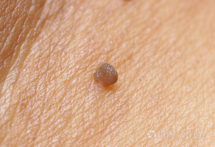 白种人皮肤乳头状瘤