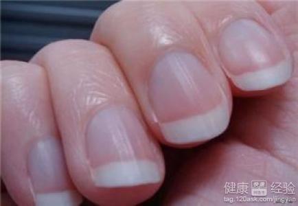 指甲营养不良怎么引起
