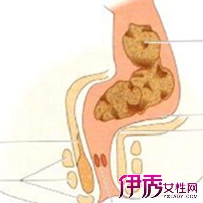 【图】肛门直肠周围脓肿图片大全 其如何诊断和治疗呢