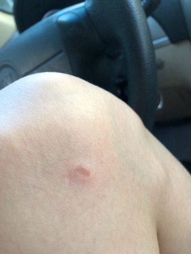 这是猫藓吗 还是皮擦破