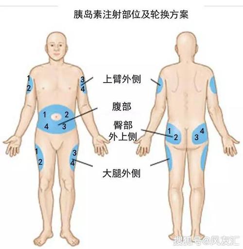 很多人的胰岛素都打错了!一文详解注射要点