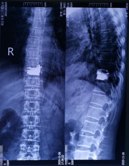 59岁胸椎压缩性骨折患者行椎体成形手术一例