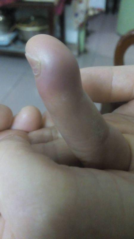 手指突然就肿起来了,碰一下都痛,是怎么回