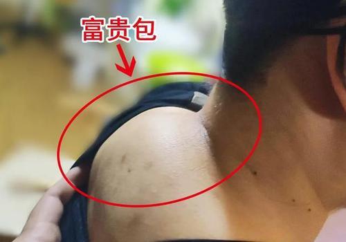 肩膀周围的肌肉僵硬,脖子曲线变直,颈椎疼痛,疼痛麻木,最终导致富贵包