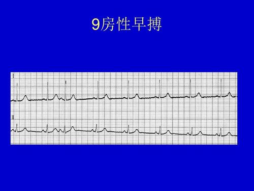 心电图典型图谱 9房性早搏
