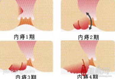 内痔疮形成的原因