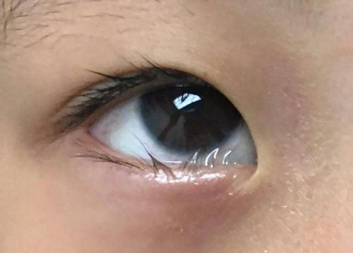 姐妹们可以通过肉眼观察小孩子的睫毛是否在眼睛里面触及到黑眼珠