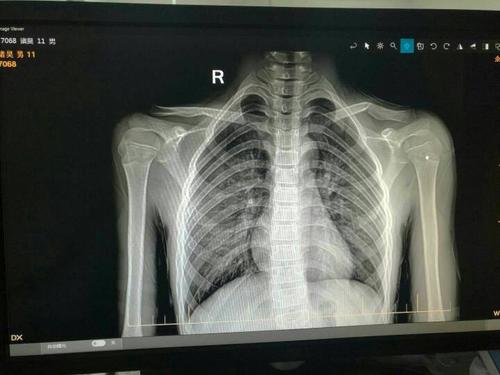 11岁的,小孩锁骨断了,是保守治疗还是动手术?