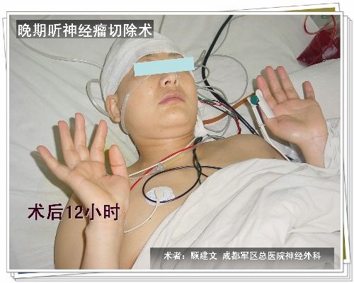 晚期听神经瘤手术