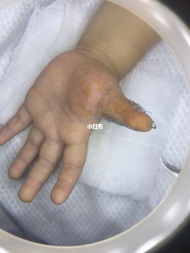 蟹钳多指手术后_儿童医院_蜕皮_保鲜袋_母婴_育儿经验
