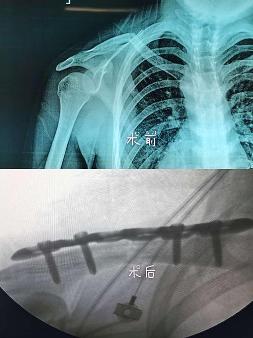 14岁男孩锁骨骨折