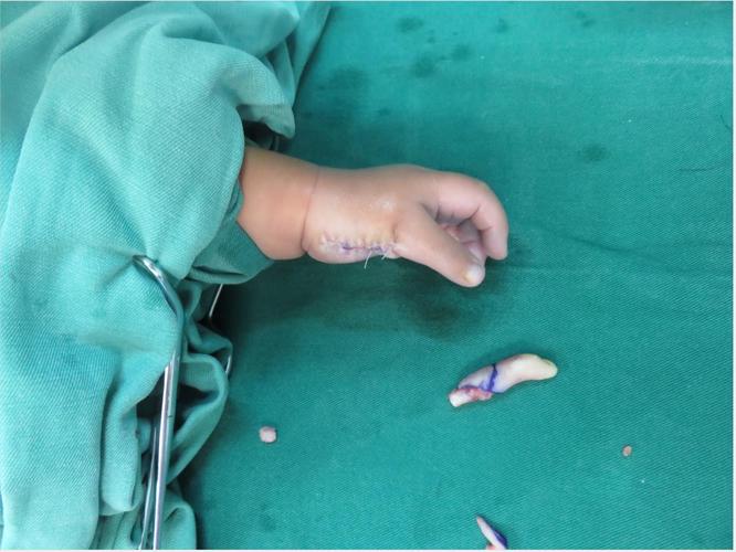 小孩多指切除案例