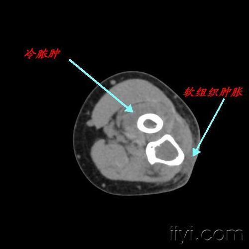 【影像表现】:右尺骨近段骨端内示边界清晰的骨质破坏区,局部骨