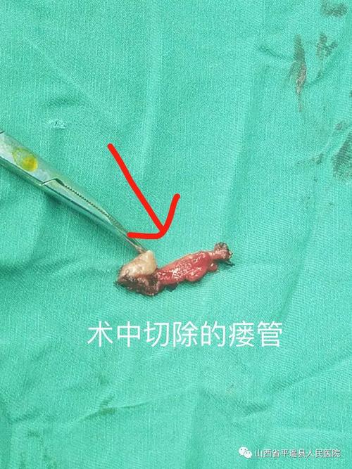 肛瘘微创术——解决您反复不愈的困扰