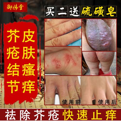 什么是疥疮结节