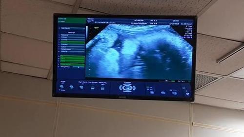 孕38周b超产检实录,可以清楚看到宝宝的脸和辫子一样的脐带