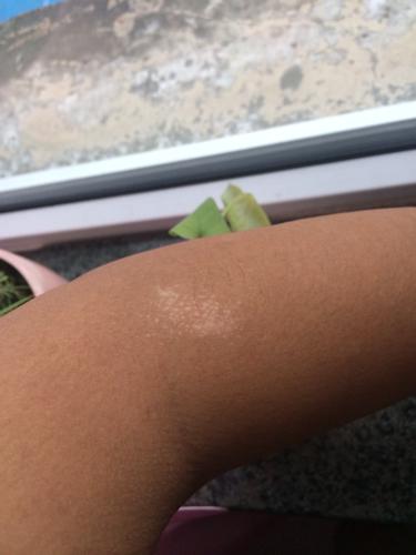 好像之前去过一次游泳馆,有一天发现左胳膊肘附近,起来一片点状白斑