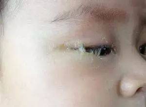 育儿| 宝宝天天泪汪汪,警惕新生儿泪囊炎!